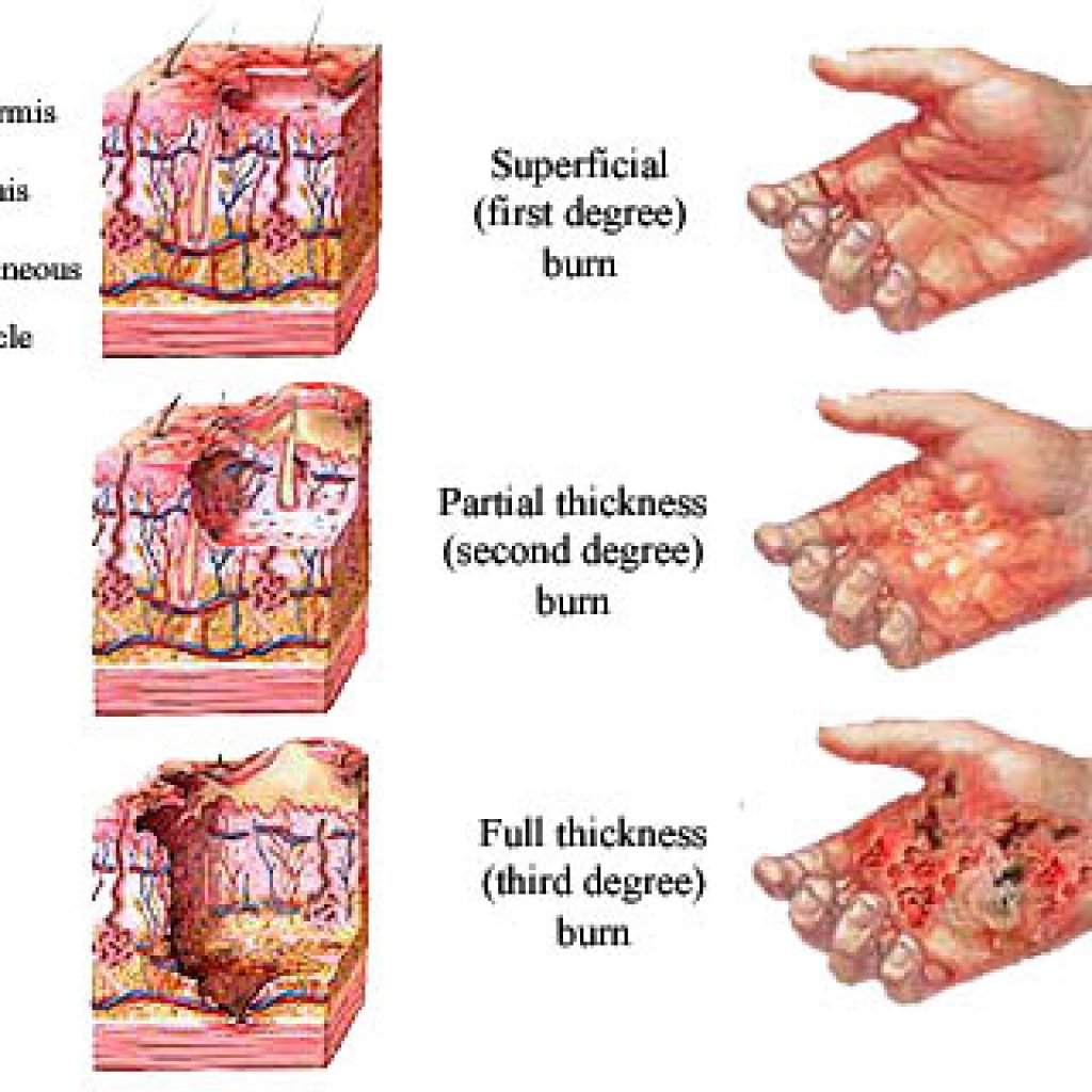 6th degree burn